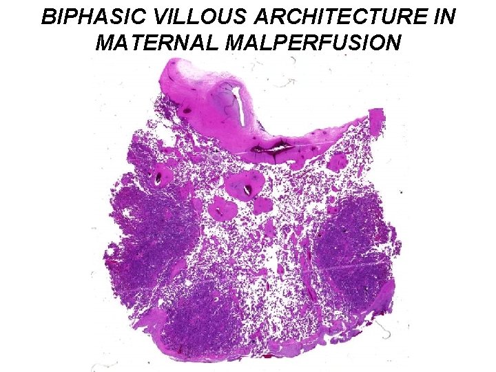 BIPHASIC VILLOUS ARCHITECTURE IN MATERNAL MALPERFUSION 