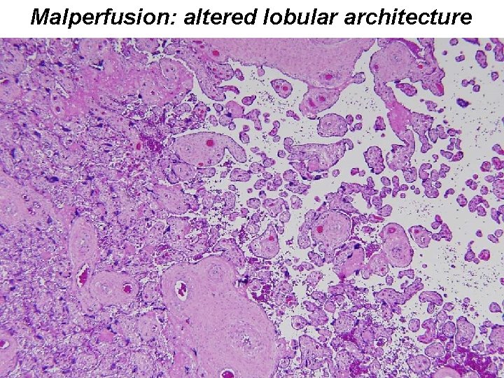 Malperfusion: altered lobular architecture 