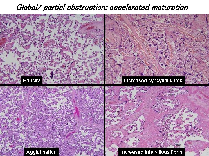 Global/ partial obstruction: accelerated maturation Paucity Agglutination Increased syncytial knots Increased intervillous fibrin 