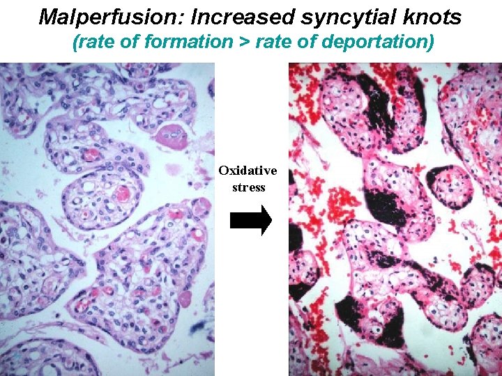 Malperfusion: Increased syncytial knots (rate of formation > rate of deportation) Oxidative stress 