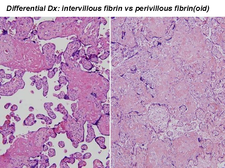 Differential Dx: intervillous fibrin vs perivillous fibrin(oid) 