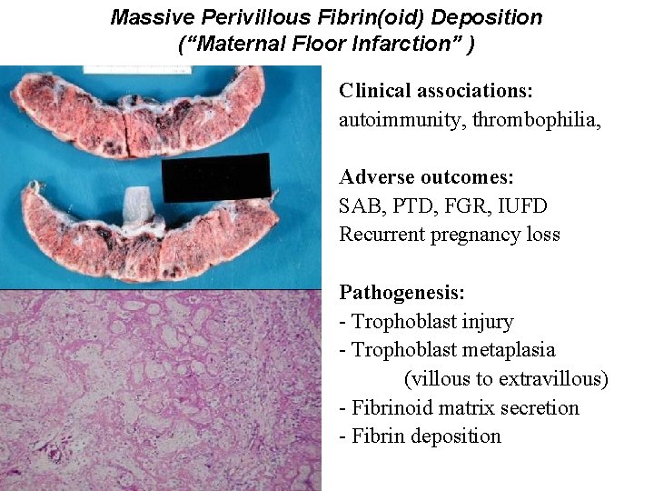 Massive Perivillous Fibrin(oid) Deposition (“Maternal Floor Infarction” ) Clinical associations: autoimmunity, thrombophilia, Adverse outcomes: