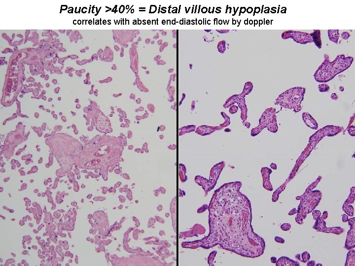 Paucity >40% = Distal villous hypoplasia correlates with absent end-diastolic flow by doppler 