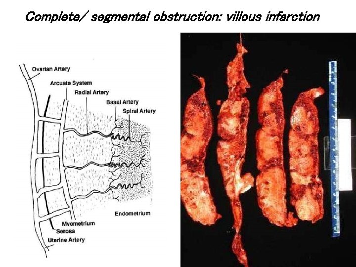 Complete/ segmental obstruction: villous infarction 