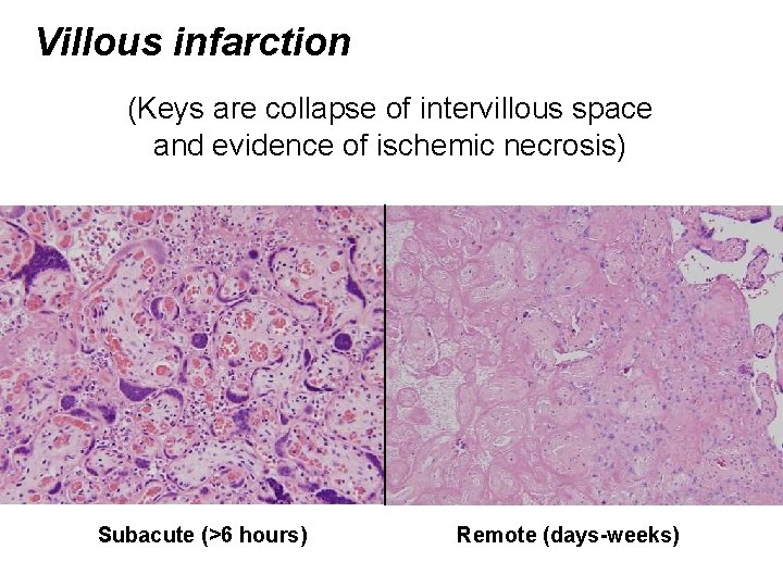 Villous infarction (Keys are collapse of intervillous space and evidence of ischemic necrosis) Subacute