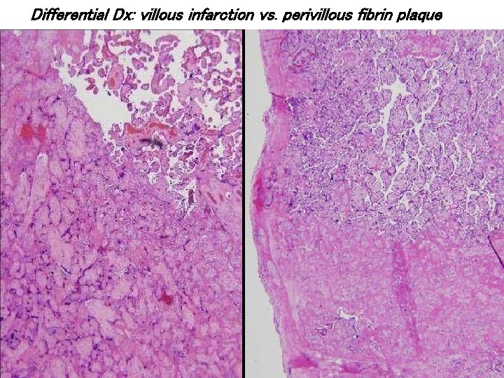 Differential Dx: villous infarction vs. perivillous fibrin plaque 