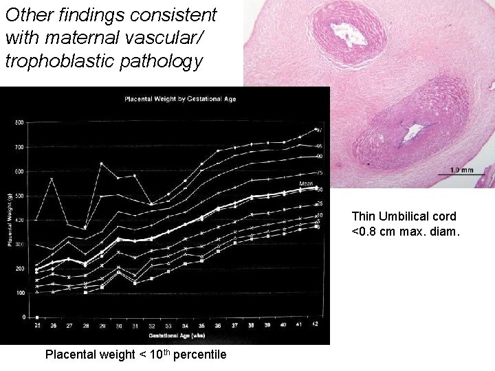 Other findings consistent with maternal vascular/ trophoblastic pathology Thin Umbilical cord <0. 8 cm