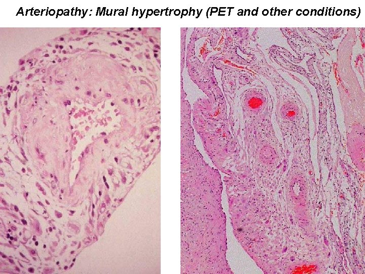 Arteriopathy: Mural hypertrophy (PET and other conditions) 