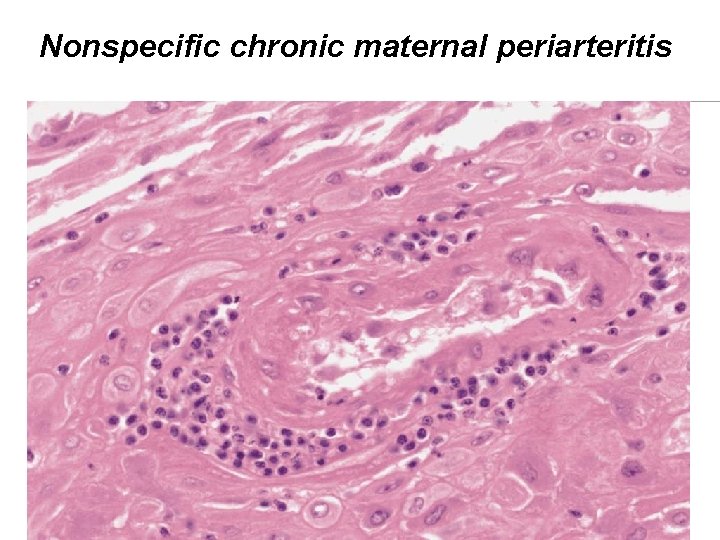 Nonspecific chronic maternal periarteritis 