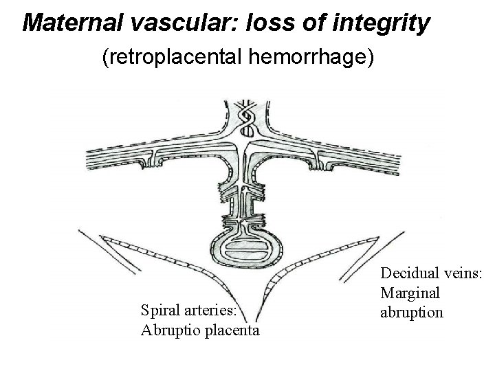 Maternal vascular: loss of integrity (retroplacental hemorrhage) Spiral arteries: Abruptio placenta Decidual veins: Marginal