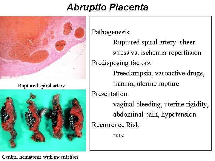 Abruptio Placenta Ruptured spiral artery Central hematoma with indentation Pathogenesis: Ruptured spiral artery: sheer