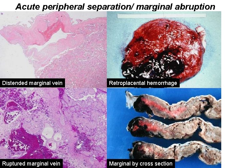 Acute peripheral separation/ marginal abruption Distended marginal vein Retroplacental hemorrhage Ruptured marginal vein Marginal