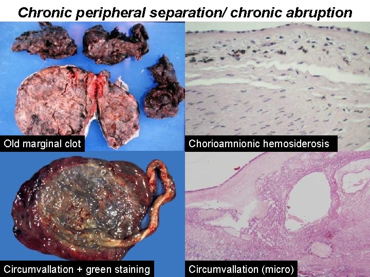 Chronic peripheral separation/ chronic abruption Old marginal clot Chorioamnionic hemosiderosis Circumvallation + green staining