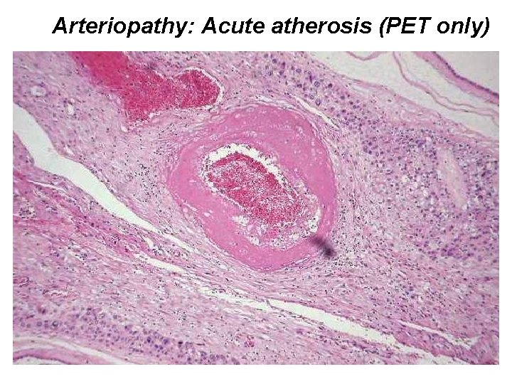 Arteriopathy: Acute atherosis (PET only) 