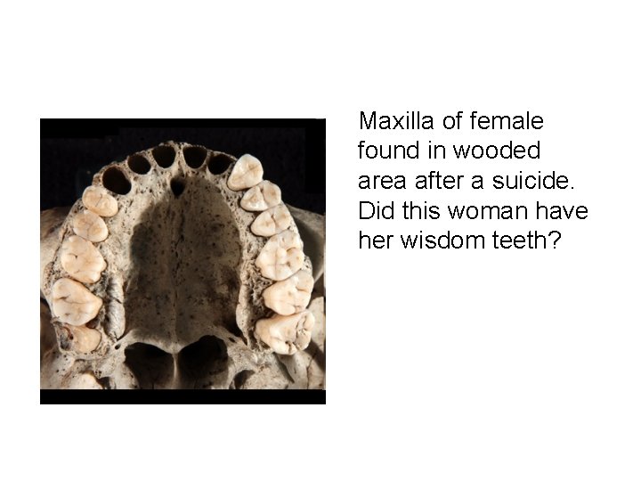 Maxilla of female found in wooded area after a suicide. Did this woman have