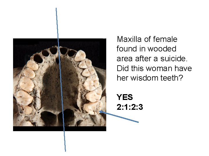 Maxilla of female found in wooded area after a suicide. Did this woman have