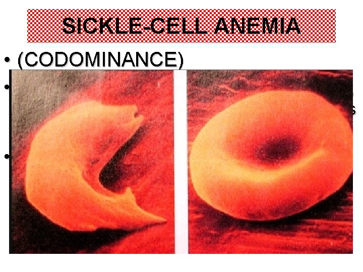 SICKLE-CELL ANEMIA • (CODOMINANCE) • Hemoglobin, the oxygen-carrying protein, differs by one amino acid, SICKLE-CELL ANEMIA • (CODOMINANCE) • Hemoglobin, the oxygen-carrying protein, differs by one amino acid,