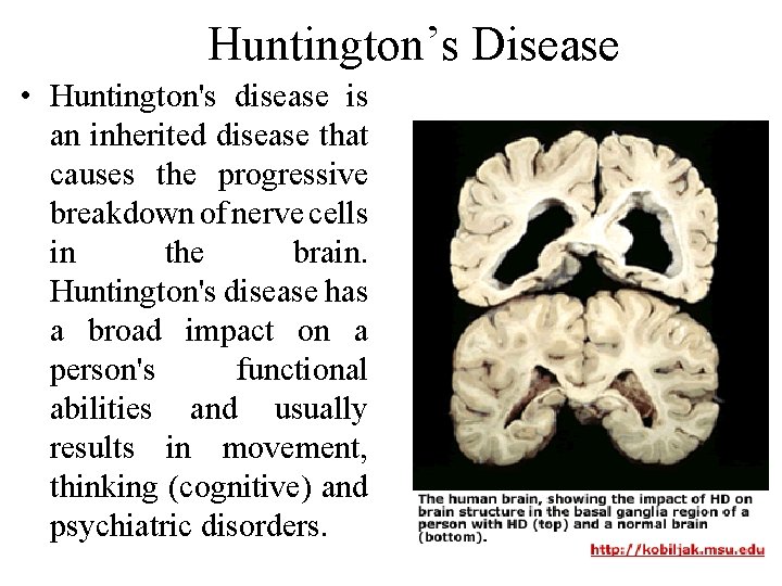 Huntington’s Disease • Huntington's disease is an inherited disease that causes the progressive breakdown Huntington’s Disease • Huntington's disease is an inherited disease that causes the progressive breakdown