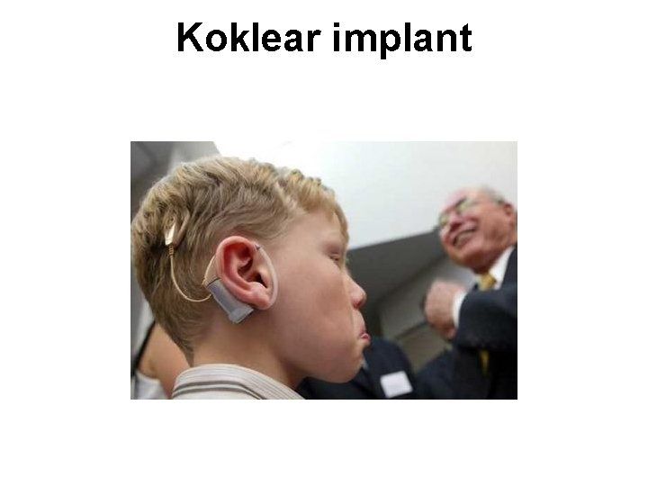 Koklear implant 