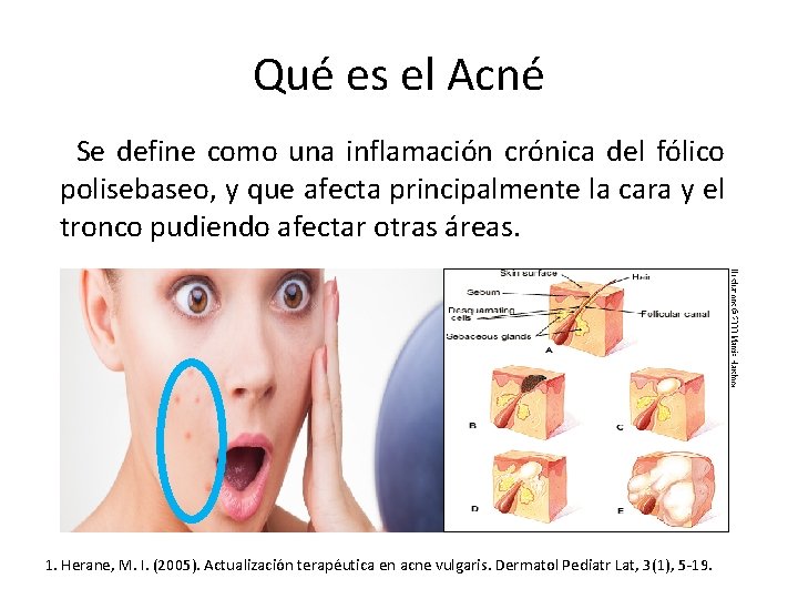 Qué es el Acné Se define como una inflamación crónica del fólico polisebaseo, y