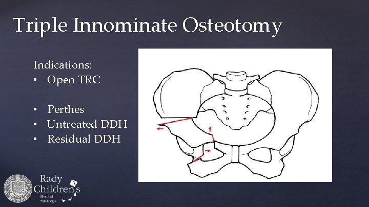 Triple Innominate Osteotomy Indications: • Open TRC • Perthes • Untreated DDH • Residual