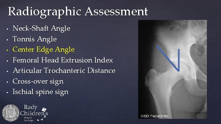 Radiographic Assessment • • Neck-Shaft Angle Tonnis Angle Center Edge Angle Femoral Head Extrusion