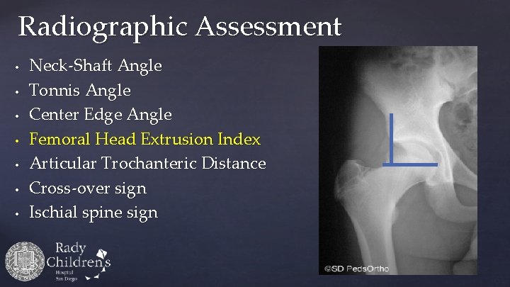 Radiographic Assessment • • Neck-Shaft Angle Tonnis Angle Center Edge Angle Femoral Head Extrusion
