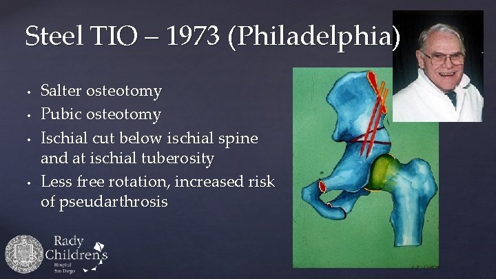 Steel TIO – 1973 (Philadelphia) • • Salter osteotomy Pubic osteotomy Ischial cut below