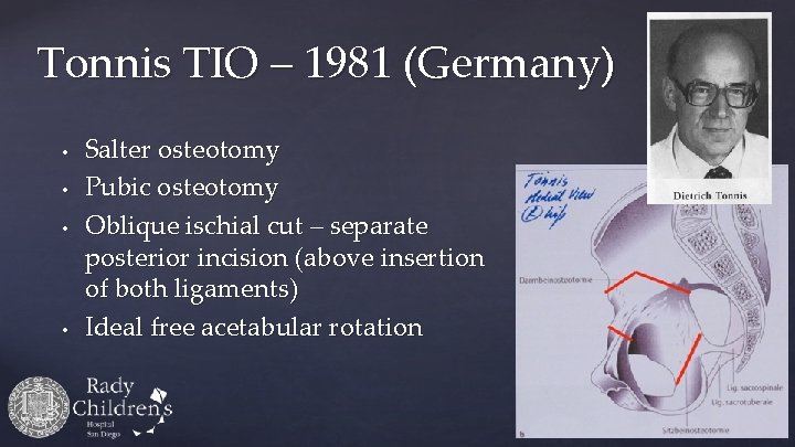 Tonnis TIO – 1981 (Germany) • • Salter osteotomy Pubic osteotomy Oblique ischial cut