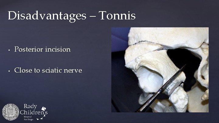Disadvantages – Tonnis • Posterior incision • Close to sciatic nerve 