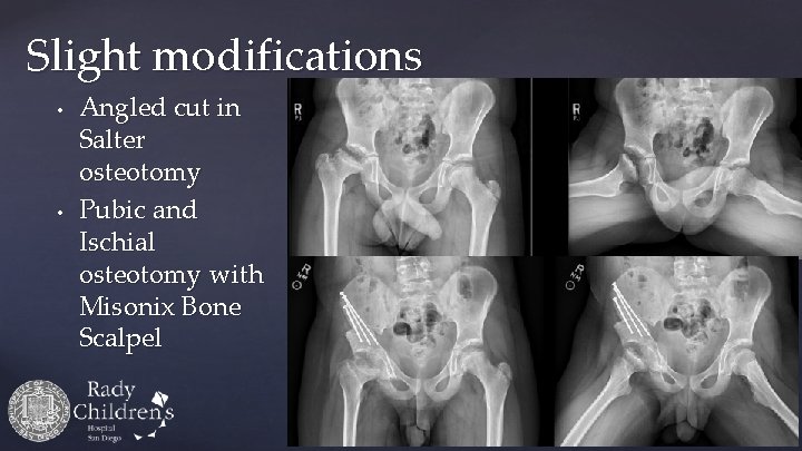 Slight modifications • • Angled cut in Salter osteotomy Pubic and Ischial osteotomy with