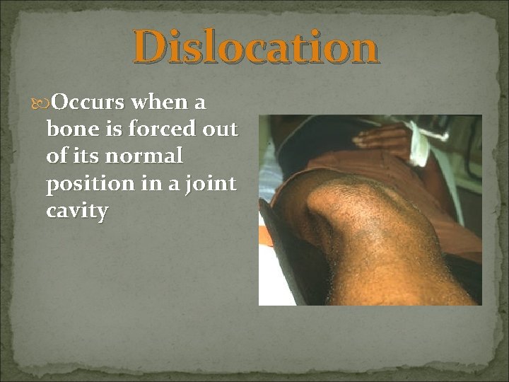 Dislocation Occurs when a bone is forced out of its normal position in a