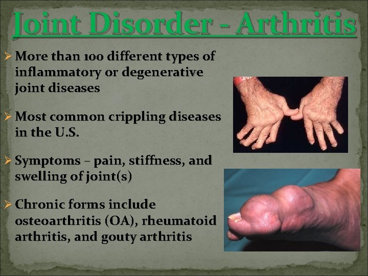 Joint Disorder - Arthritis Ø More than 100 different types of inflammatory or degenerative