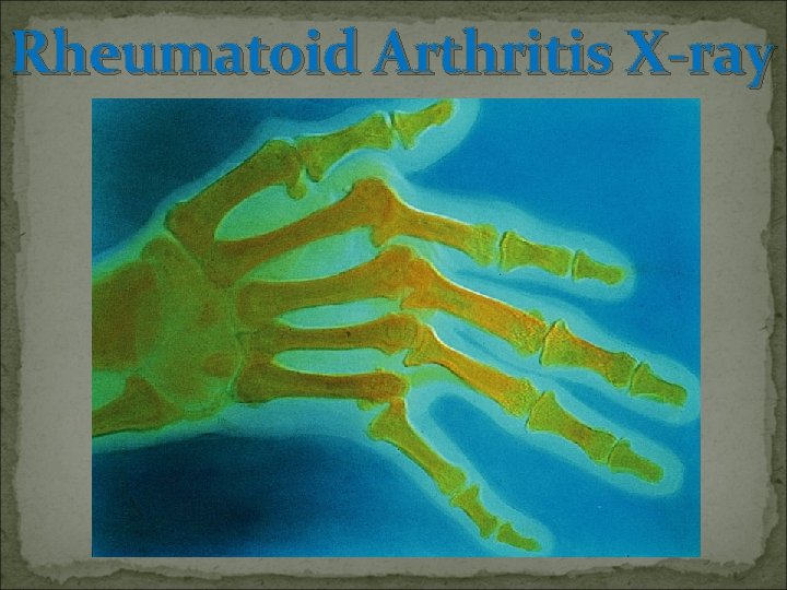 Rheumatoid Arthritis X-ray 