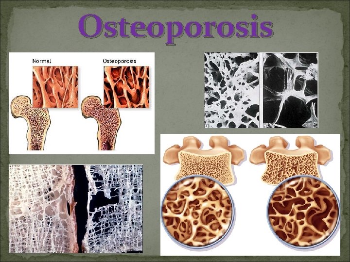 Osteoporosis 