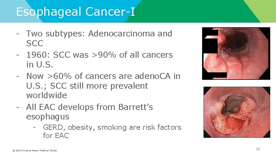 Esophageal Cancer-I - Two subtypes: Adenocarcinoma and SCC - 1960: SCC was >90% of