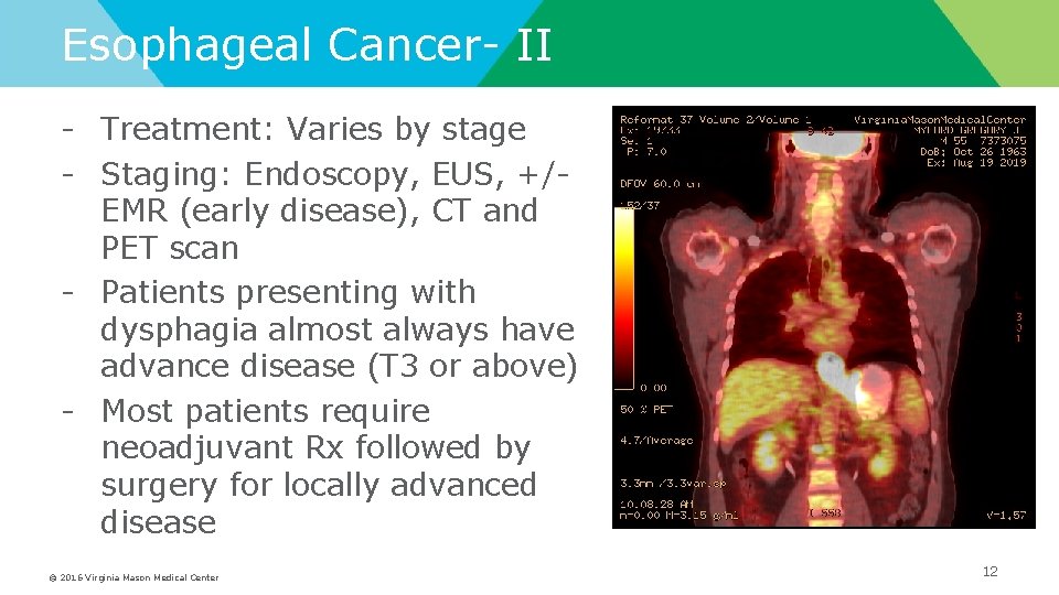 Esophageal Cancer- II - Treatment: Varies by stage - Staging: Endoscopy, EUS, +/EMR (early