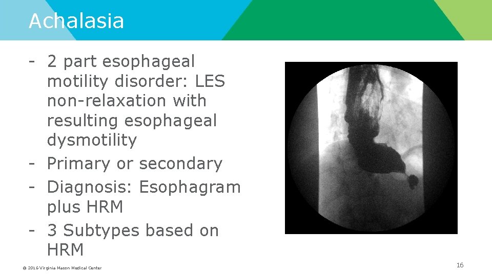 Achalasia - 2 part esophageal motility disorder: LES non-relaxation with resulting esophageal dysmotility -