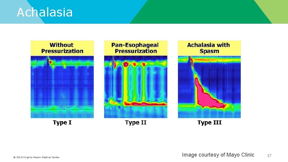 Achalasia © 2016 Virginia Mason Medical Center Image courtesy of Mayo Clinic 17 