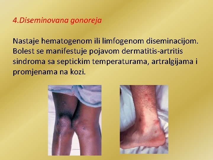 4. Diseminovana gonoreja Nastaje hematogenom ili limfogenom diseminacijom. Bolest se manifestuje pojavom dermatitis-artritis sindroma