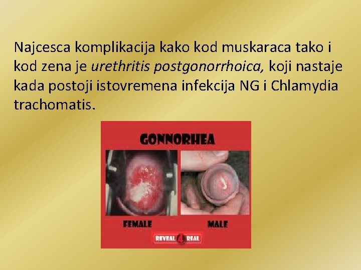 Najcesca komplikacija kako kod muskaraca tako i kod zena je urethritis postgonorrhoica, koji nastaje