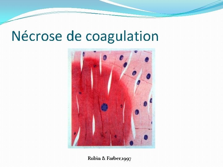 Nécrose de coagulation Rubin & Farber, 1997 