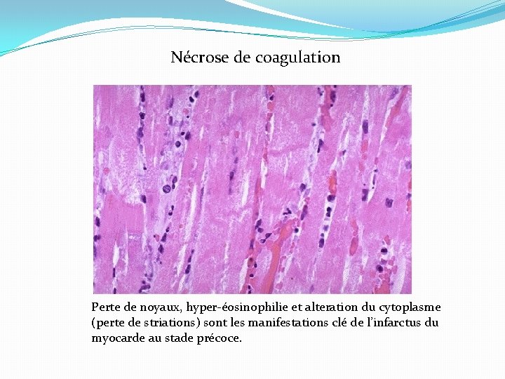 Nécrose de coagulation Perte de noyaux, hyper-éosinophilie et alteration du cytoplasme (perte de striations)