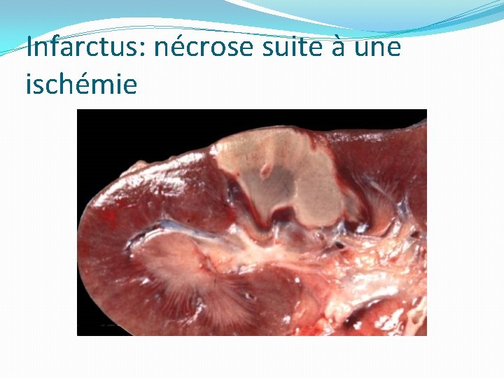 Infarctus: nécrose suite à une ischémie 