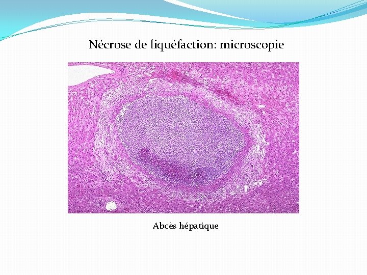 Nécrose de liquéfaction: microscopie Abcès hépatique 