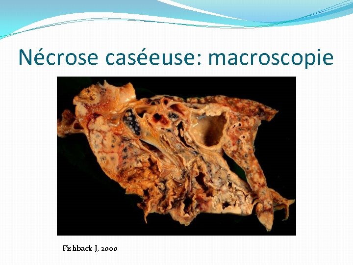 Nécrose caséeuse: macroscopie Fishback J, 2000 