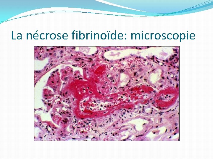 La nécrose fibrinoïde: microscopie 
