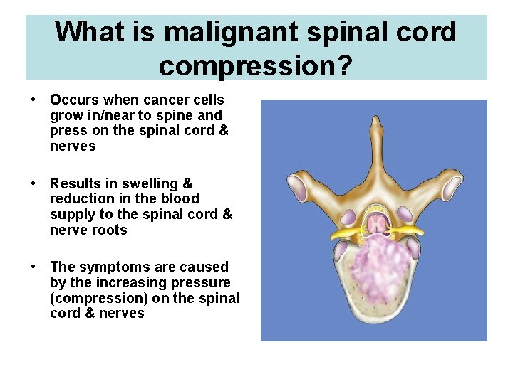 What is malignant spinal cord compression? • Occurs when cancer cells grow in/near to