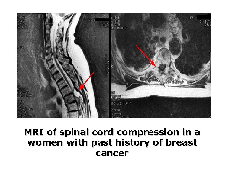 MRI of spinal cord compression in a women with past history of breast cancer