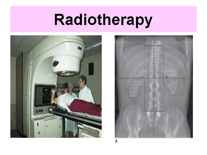 Radiotherapy 